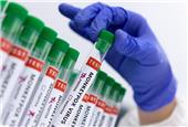 تولید کیت‌های تشخیص آبله میمونی در کشور/ هنوز الزامی برای تزریق واکسن آبله نیست